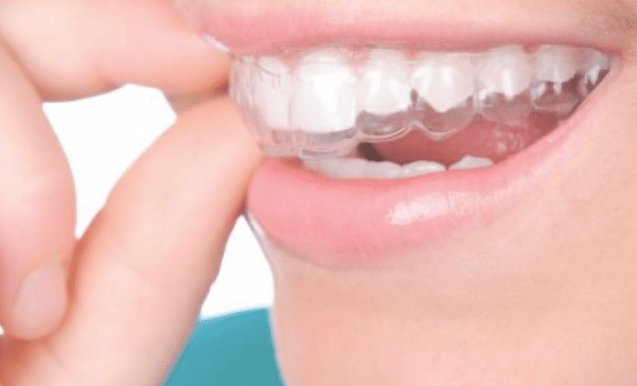 alignement des dents - gouttière - cabinet médicaux dentaire
