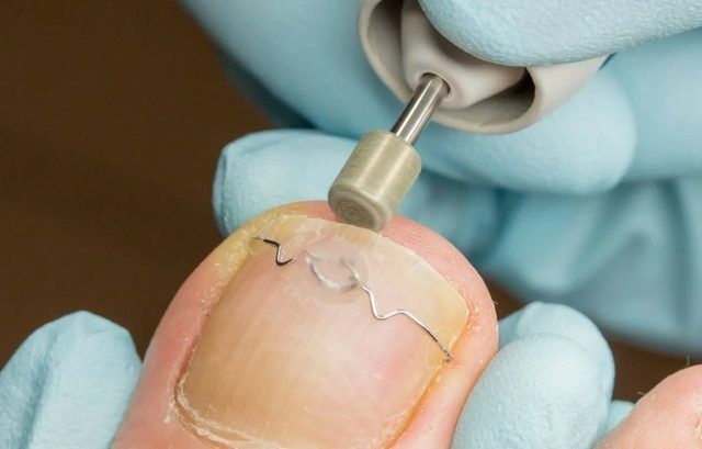 Eine behandschuhte Hand entfernt mit einem elektrischen Hornhautentferner Hornhaut in der Nähe des großen Zehs