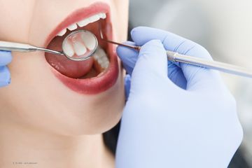 Zahnarztkontrolle mit einem Spiegel