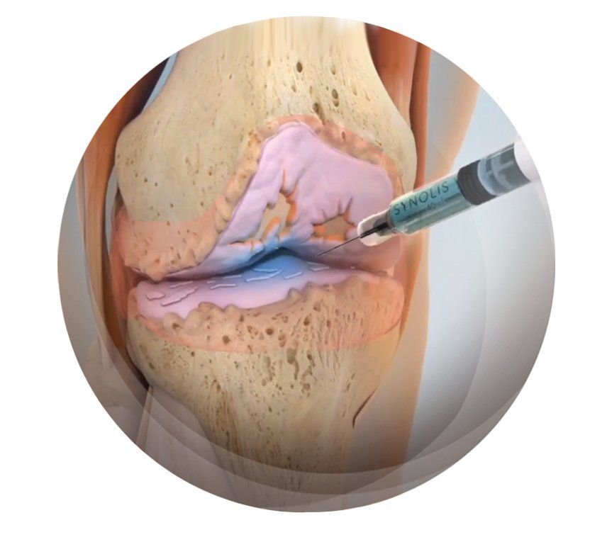 Image 3D injection dans le genou