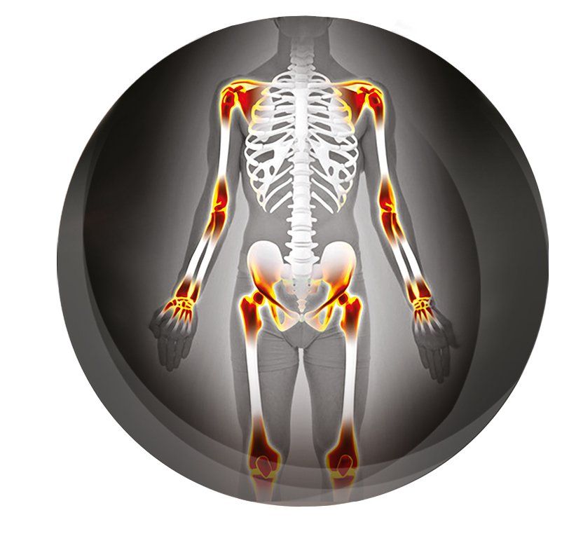 Schéma squelette avec zones sensibles à l'arthrose en rouge