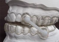 Laboratoire dentaire Chantal Clerc - Gouttière anti-ronflement silensor