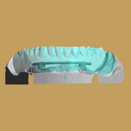 Laboratoire dentaire Chantal Clerc - implants