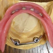 Laboratoire dentaire Chantal Clerc - implants