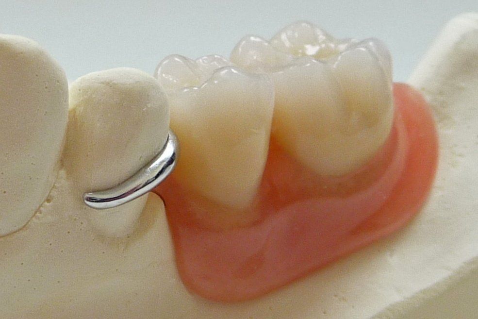 Laboratoire dentaire Chantal Clerc - Détail d'un appareil stellite terminé