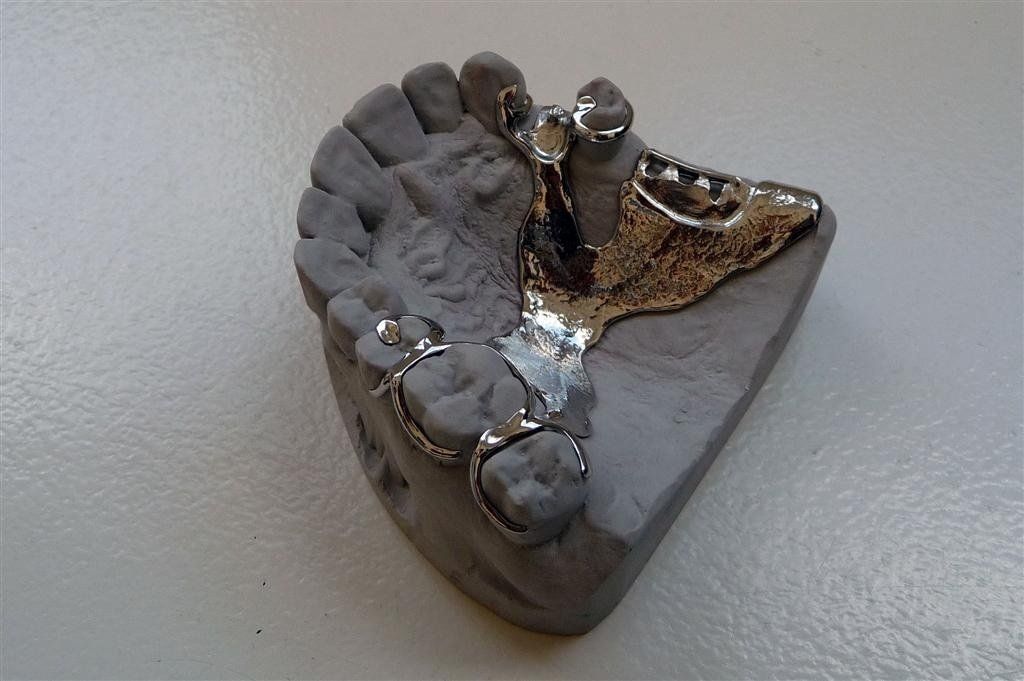 Laboratoire dentaire Chantal Clerc - Stellite supérieur