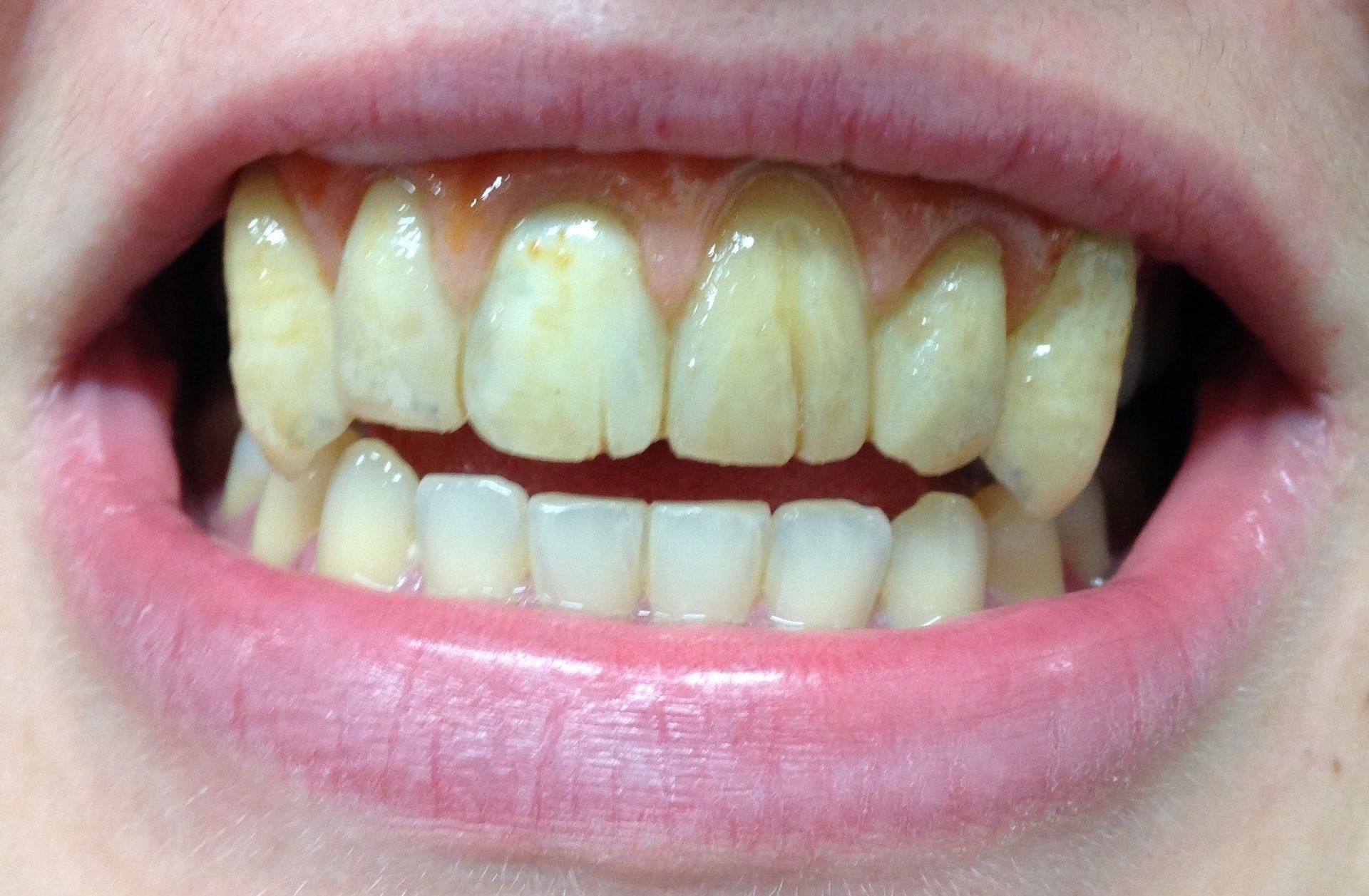 Laboratoire dentaire Chantal Clerc - Détail d'un appareil stellite terminé