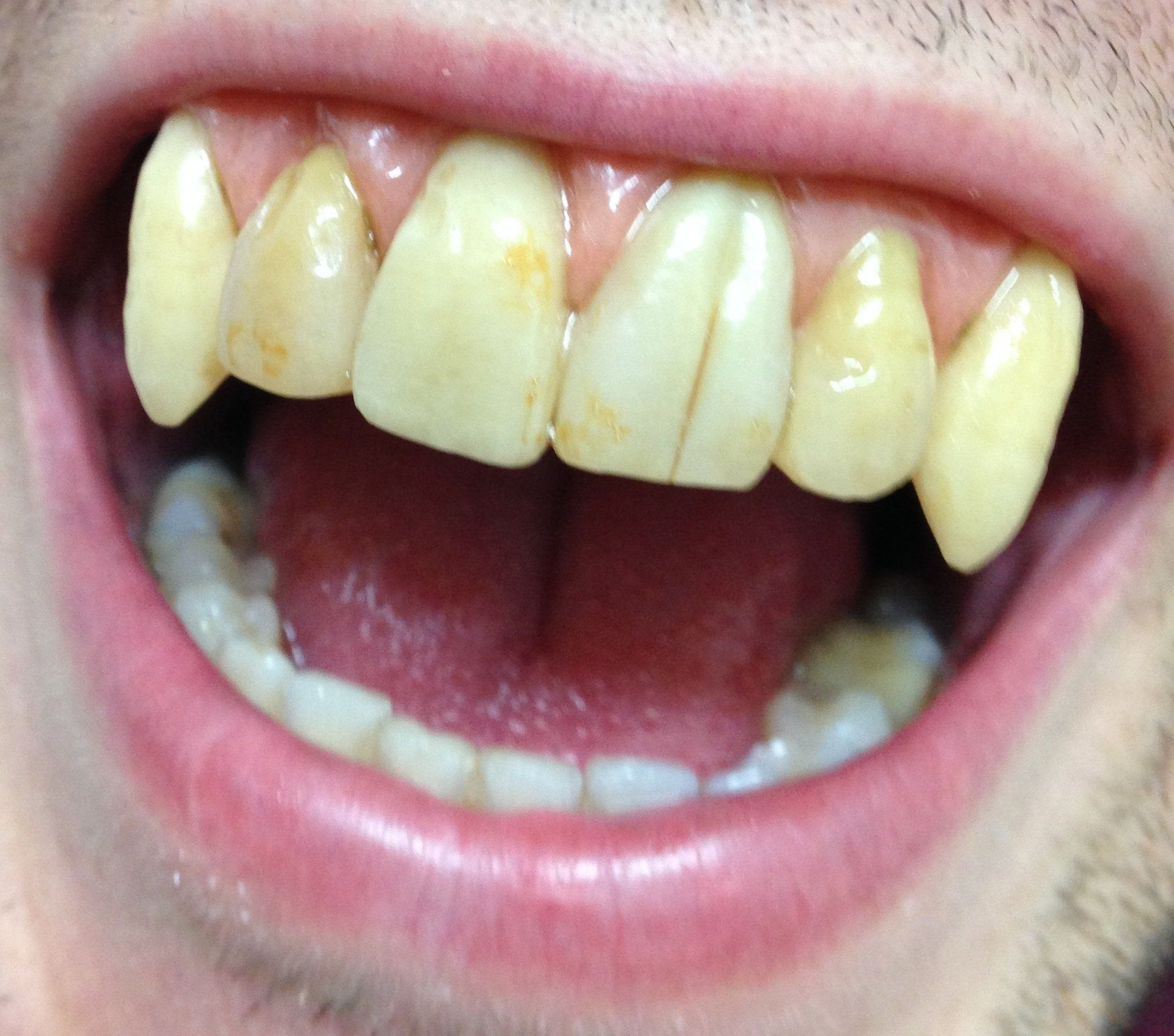 Laboratoire dentaire Chantal Clerc - Détail d'un appareil stellite terminé