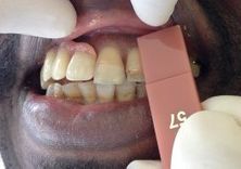 Laboratoire dentaire Chantal Clerc - gencive brune, tachetée