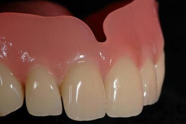 Laboratoire dentaire Chantal Clerc - système d'injection Ivocap