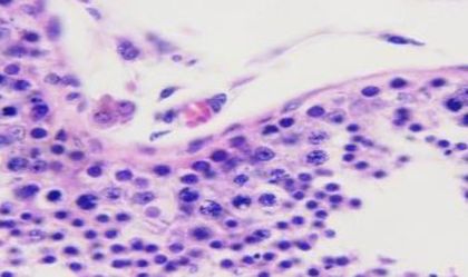 Muestra de tejido microscópica con células teñidas de púrpura y fibras conectivas rosadas.