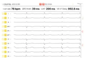 Una pantalla de computadora muestra el latido del corazón de una persona