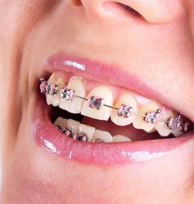Un primer plano de la boca de una mujer con aparatos dentales.