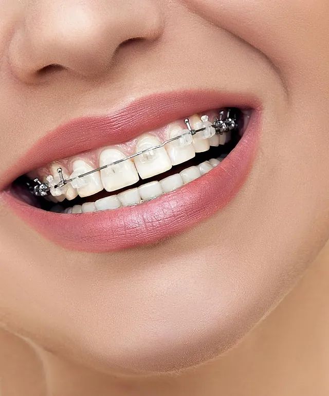 Un primer plano de la boca de una mujer con aparatos dentales.
