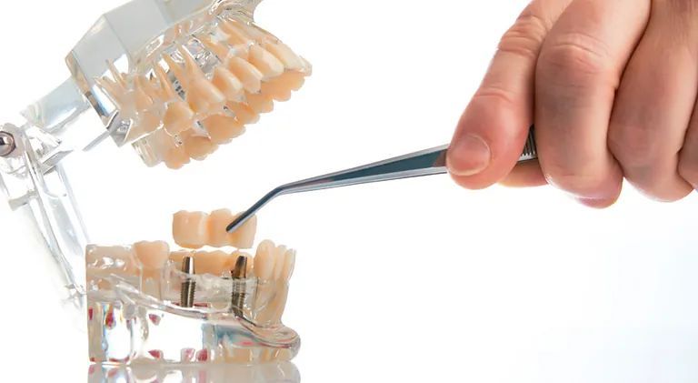 Una persona sostiene un par de pinzas sobre un modelo de dientes.