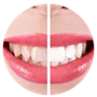 Un primer plano de los dientes de una mujer antes y después del blanqueamiento.