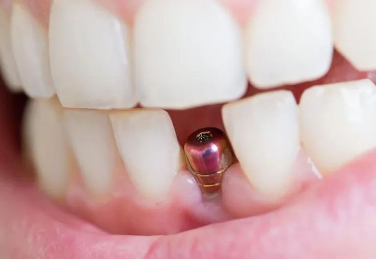 Un primer plano de los dientes de una persona con un implante dental.