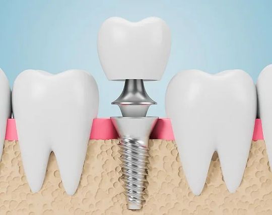 Un primer plano de un diente con un implante dental.