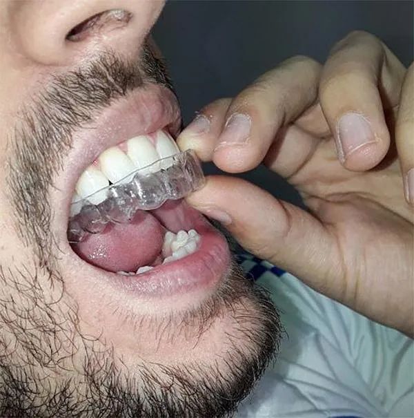 Un hombre con barba se está colocando un aparato transparente en los dientes.