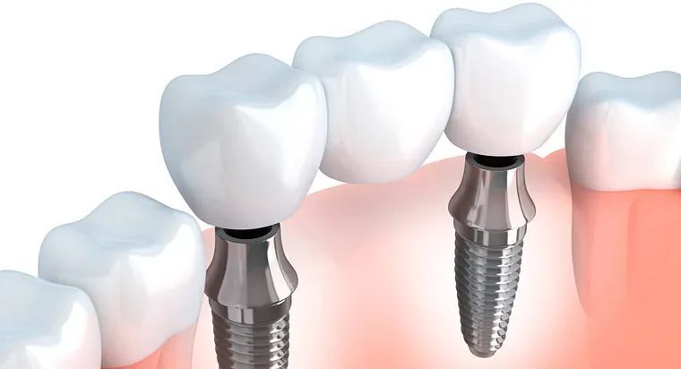 Una imagen generada por computadora de un puente hecho de implantes dentales.