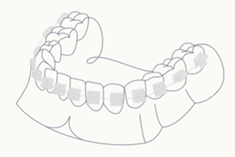 Zähne mit Brackets und Draht, die eine kieferorthopädische Behandlung zeigen.