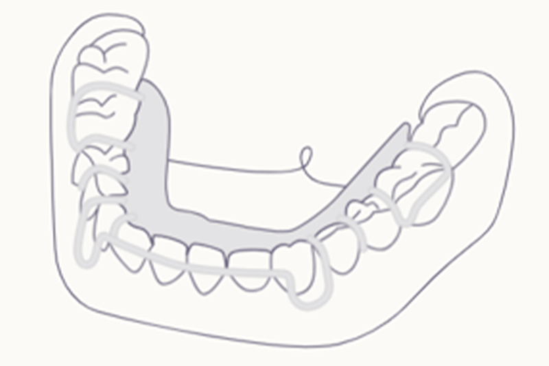 Schema einer Teilprothese im Unterkiefer, die das Metallgerüst und die Ersatzzähne zeigt.