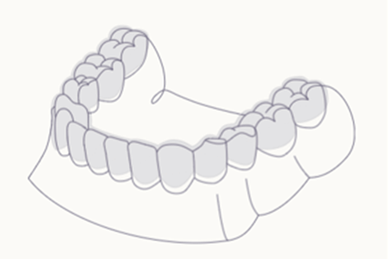 Transparente Zahnspange, die der Mundform angepasst ist, mit einem Drahtbügel obenauf.