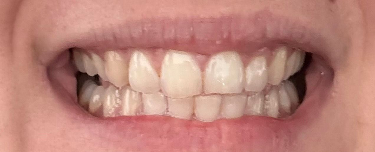 Lähikuva henkilön suusta, jossa näkyy hampaat ja lievä ylipurenta, luonnonvalossa.