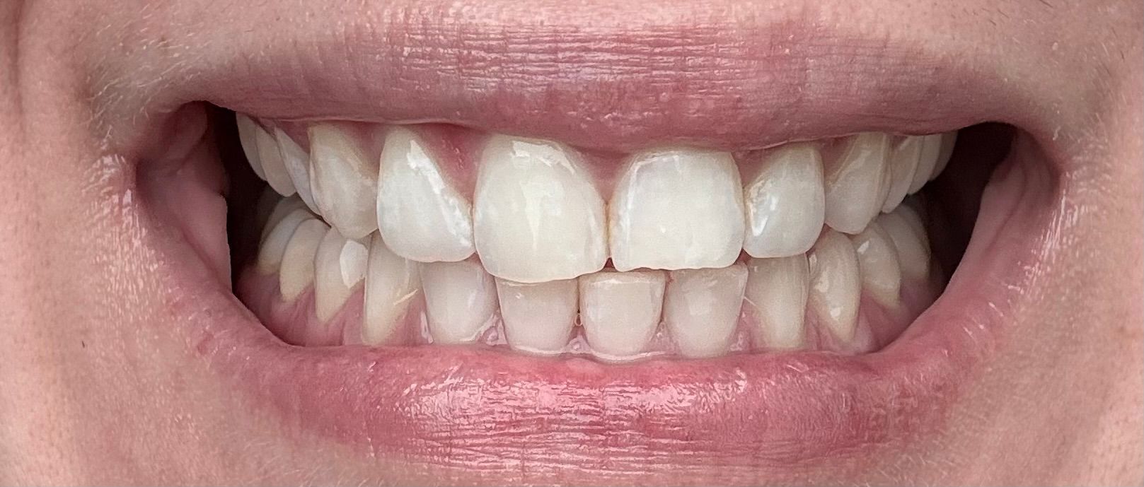 Lähikuva hymyilevästä suusta, jossa näkyvät puhtaat, suorat hampaat ja terveet ikenet.