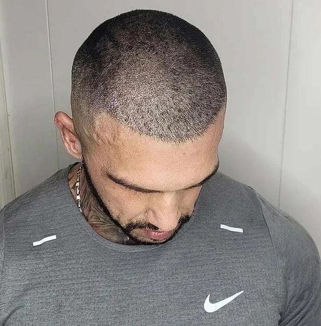 Hombre con la cabeza rapada, vestido con una camisa gris, mirando hacia abajo y mostrando micropigmentación del cuero cabelludo.