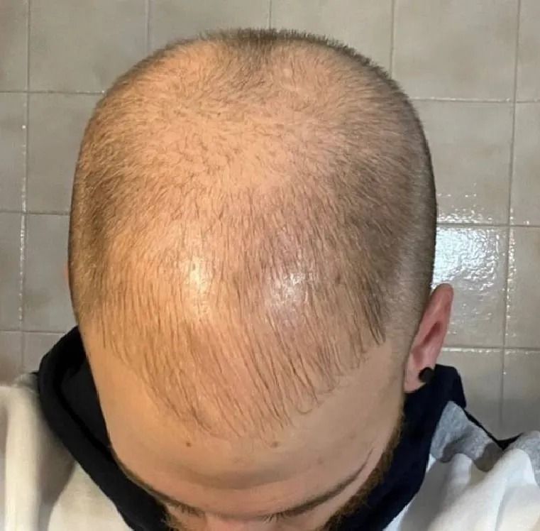 Un hombre con la cabeza rapada, cabello ralo y perilla, mirando hacia abajo.