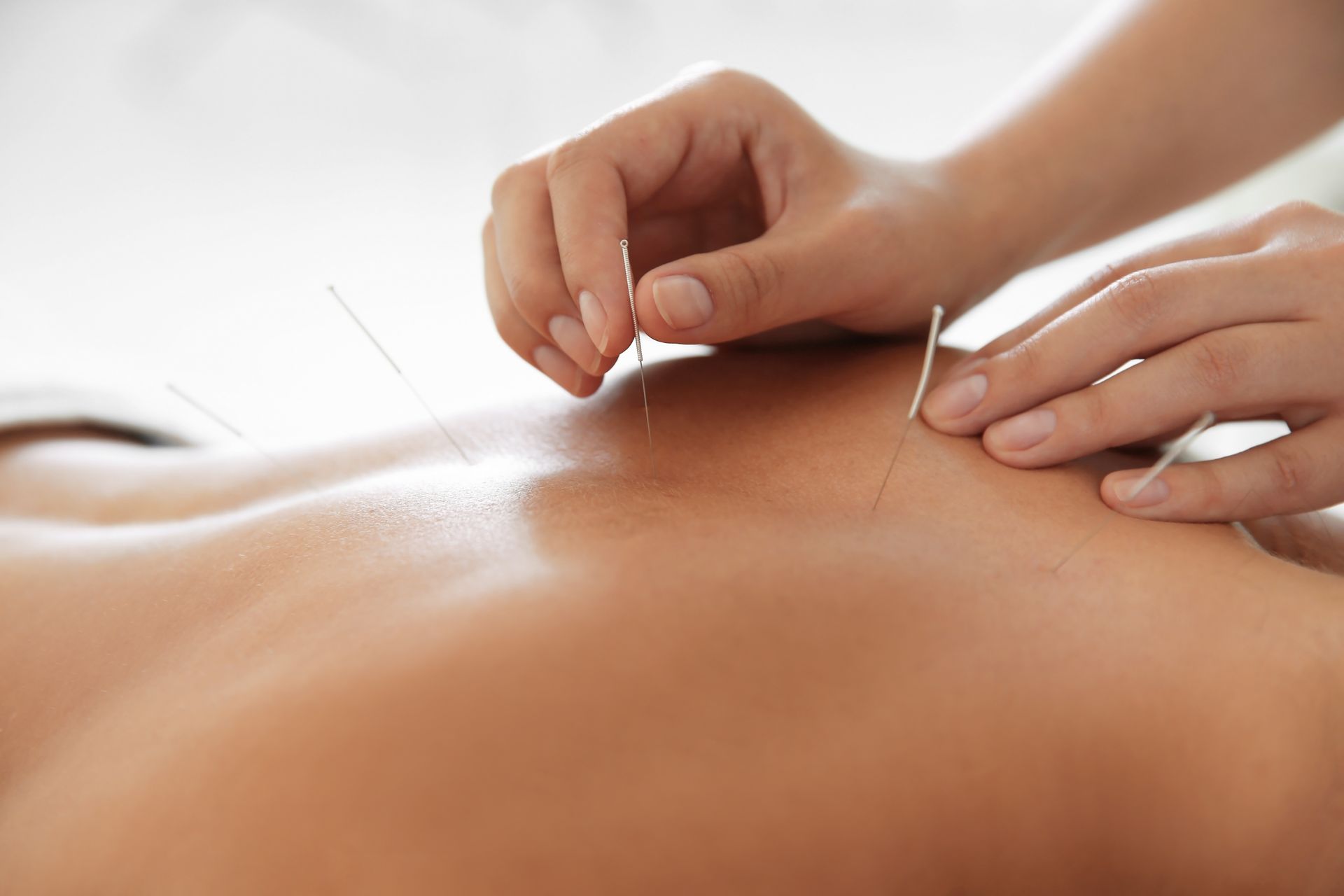 Des mains posent des aiguilles d'acupuncture dans le dos nu d'une personne