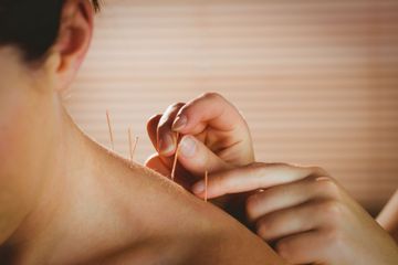 Aiguilles d'acupuncture insérées dans le haut du dos et la nuque d'une personne par un praticien