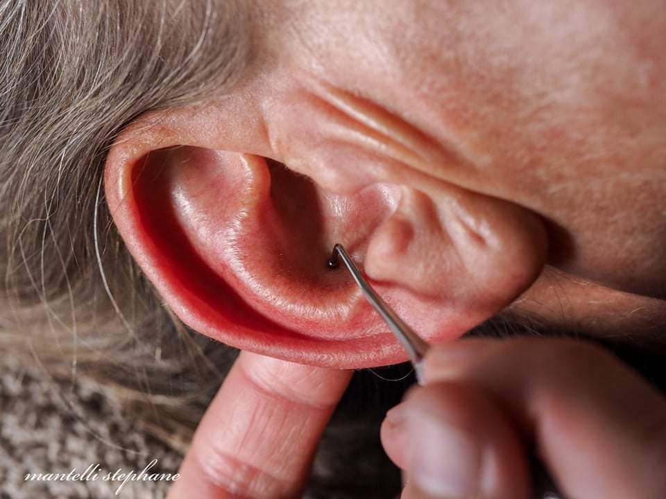 Gros plan d'une oreille avec un outil d'auriculothérapie