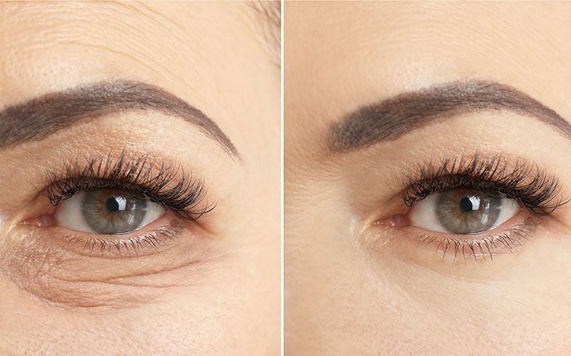 Ein Vorher-Nachher-Foto der Augen einer Frau.