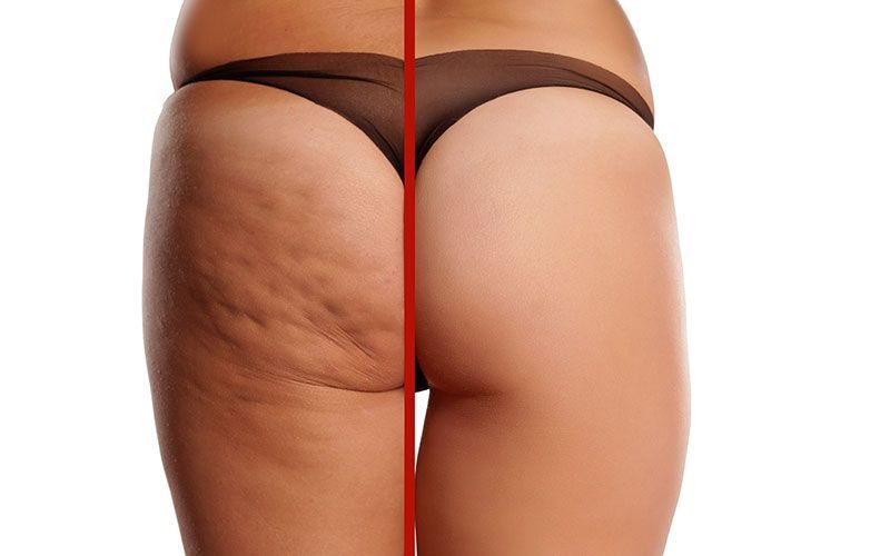 Cellulite Behandlung