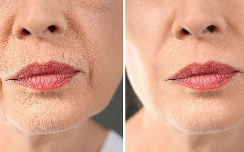 Ein Vorher-Nachher-Foto des Gesichts einer Frau mit Falten.