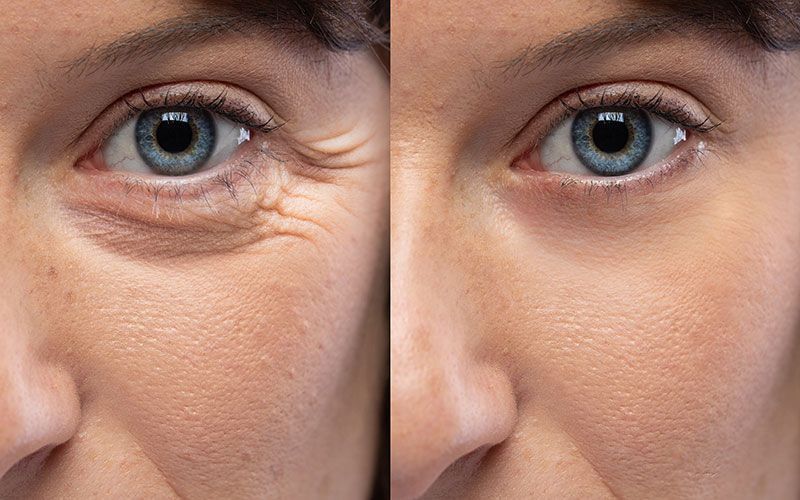 Ein Vorher-Nachher-Foto des Auges einer Frau mit Fältchen.