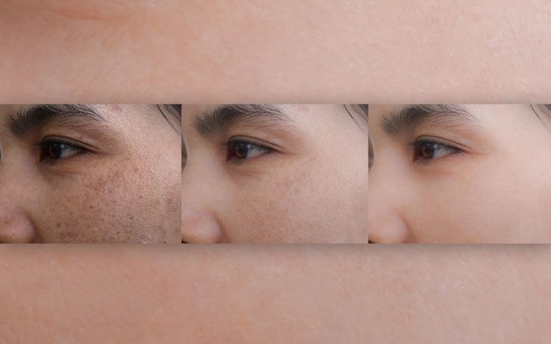 Ein Vorher-Nachher-Foto des Gesichts eines Mannes.