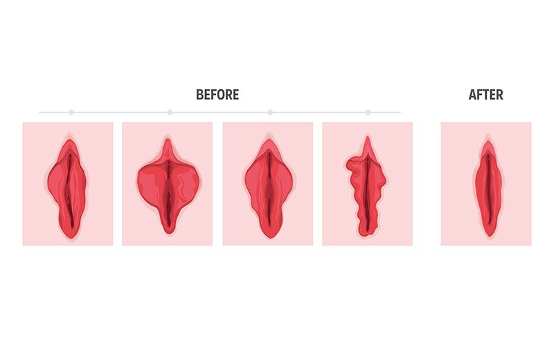 Schamlippenkorrektur