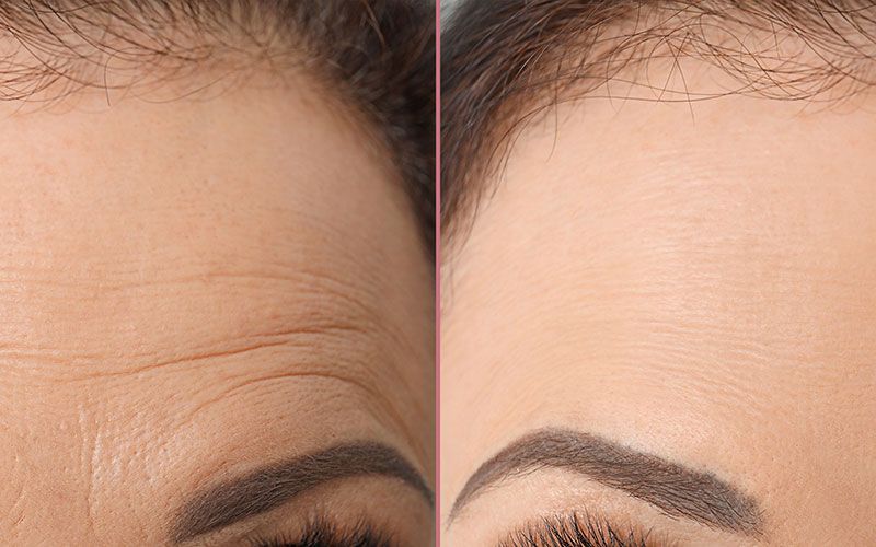 Ein Vorher-Nachher-Foto der Stirn einer Frau.
