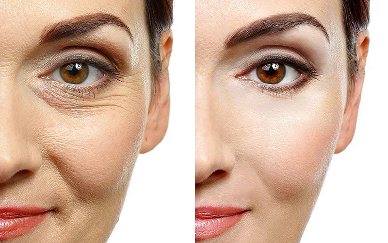 Ein Vorher-Nachher-Foto vom Gesicht einer Frau.