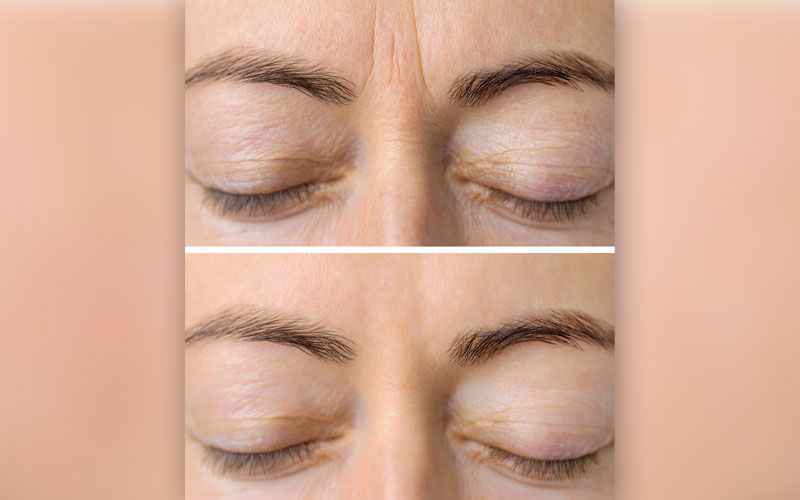 Ein Vorher-Nachher-Foto der Augen einer Frau.