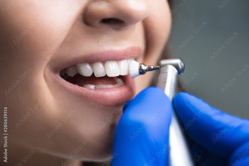 Persona che si fa lucidare i denti dal dentista con uno strumento odontoiatrico, primo piano.