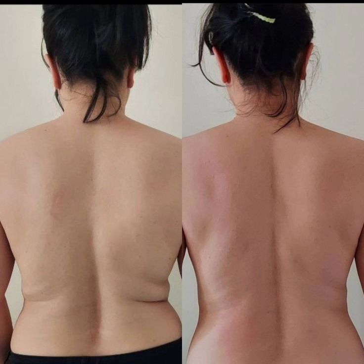 Dos espaldas una al lado de la otra, mostrando una diferencia en la línea del bronceado desde el hombro hasta la cintura.