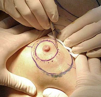 Cirugía de mama: manos con guantes utilizando un bisturí sobre una mama marcada con líneas quirúrgicas.