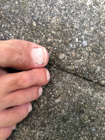 Zeh mit teilweise abgelöstem Zehennagel auf einer grauen Betonoberfläche.