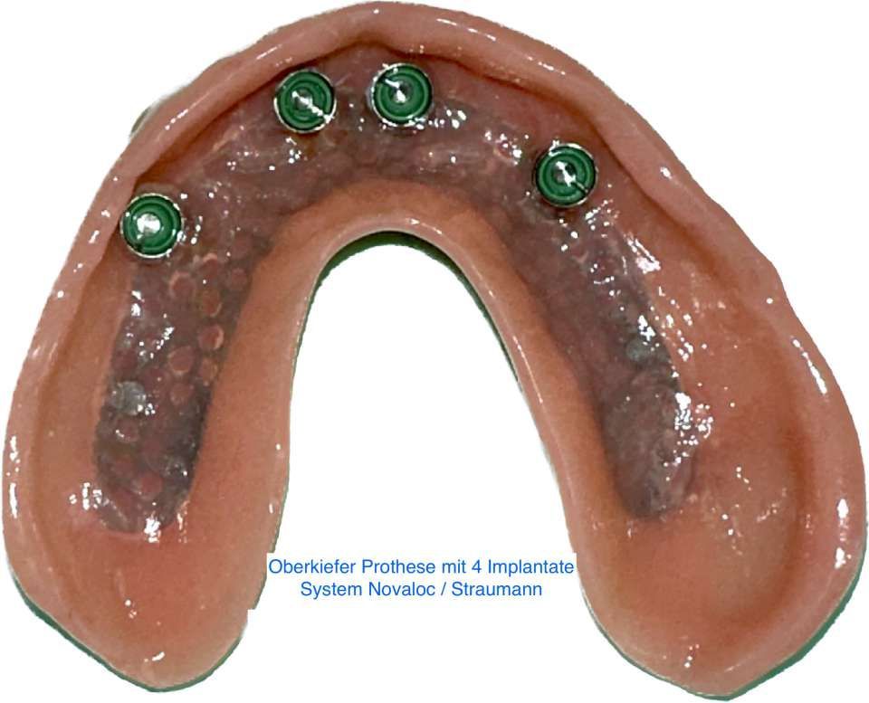 Zahnprothetik Zürich Orribile Alberto Zürich Arbeit mit Locator Implantate