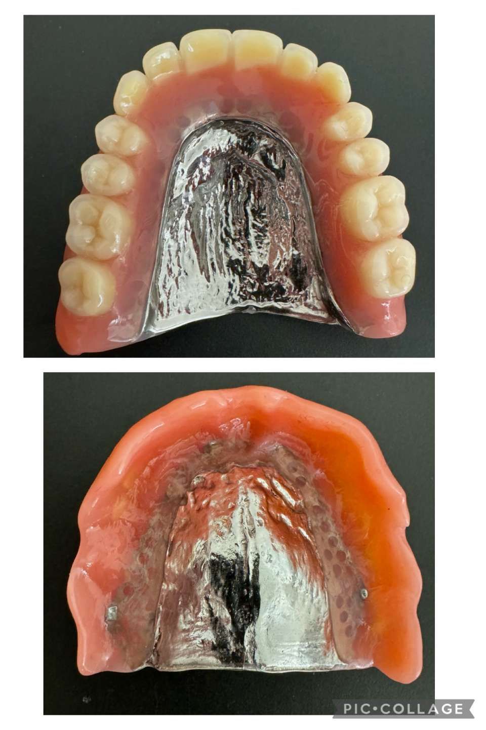Zahnprothetik Orribile, Prothese