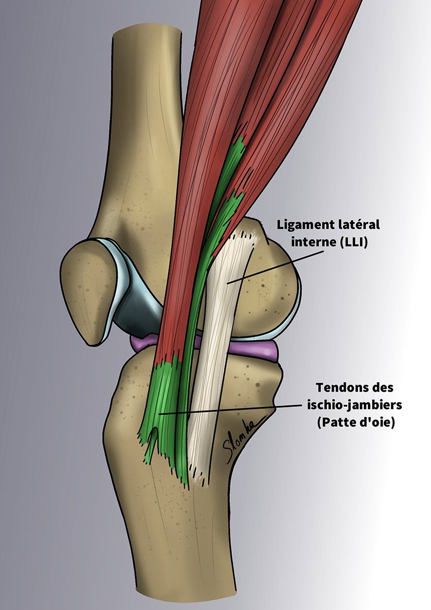 Illustration du DIDT+LCA1